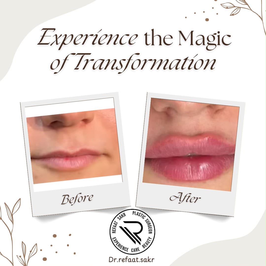 Result — Lip Augmentation