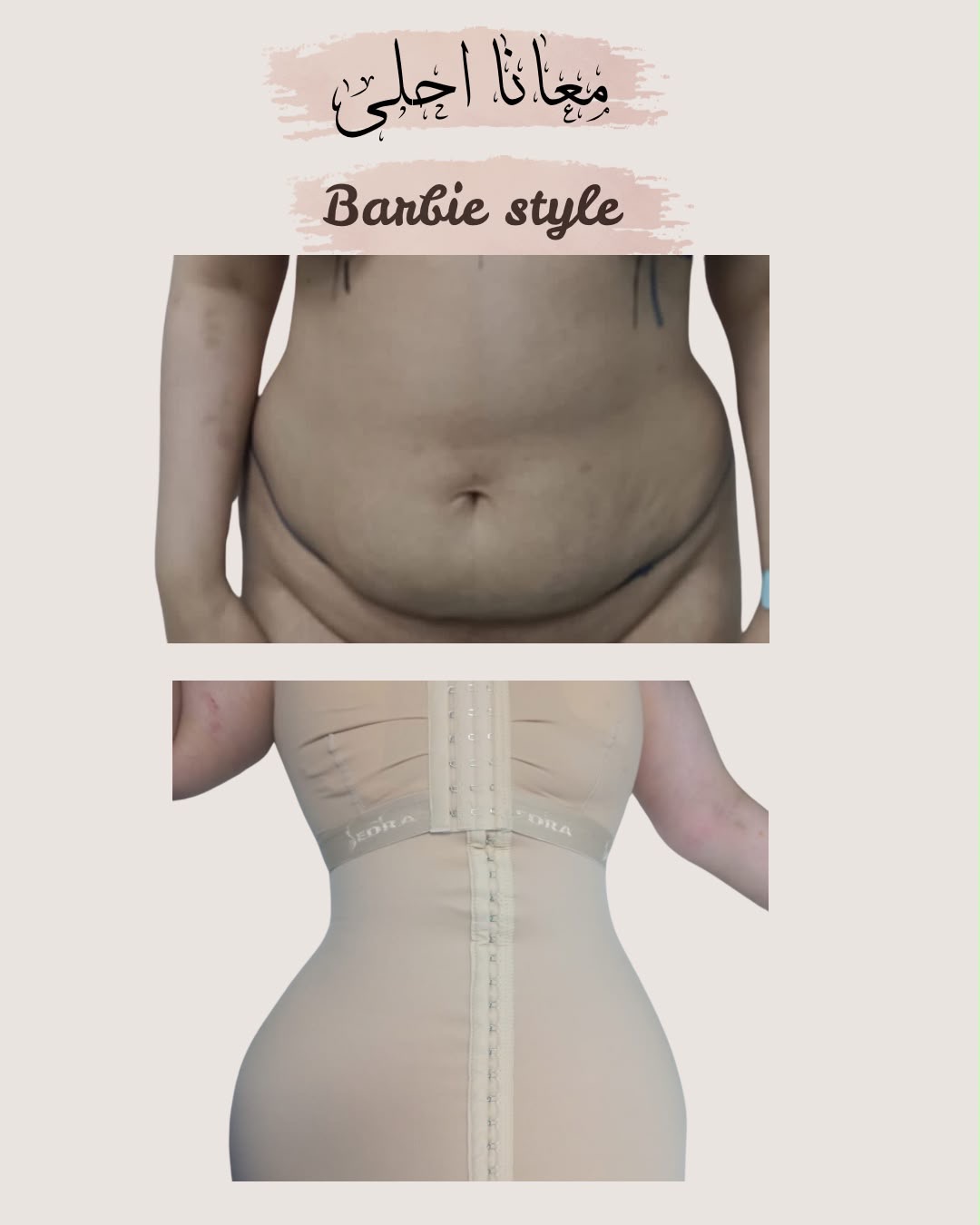 Result — Liposuction