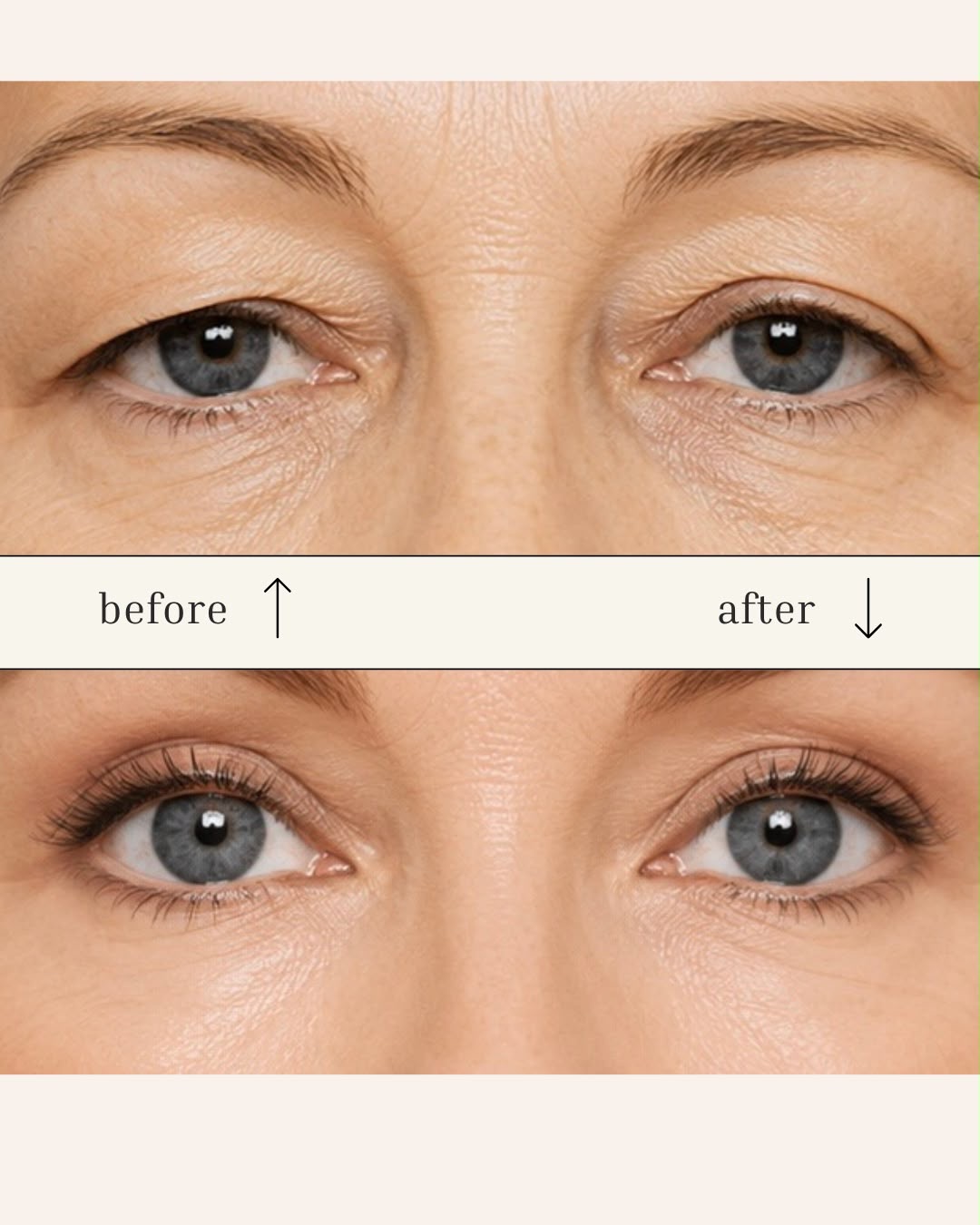 Result — Blepharoplasty