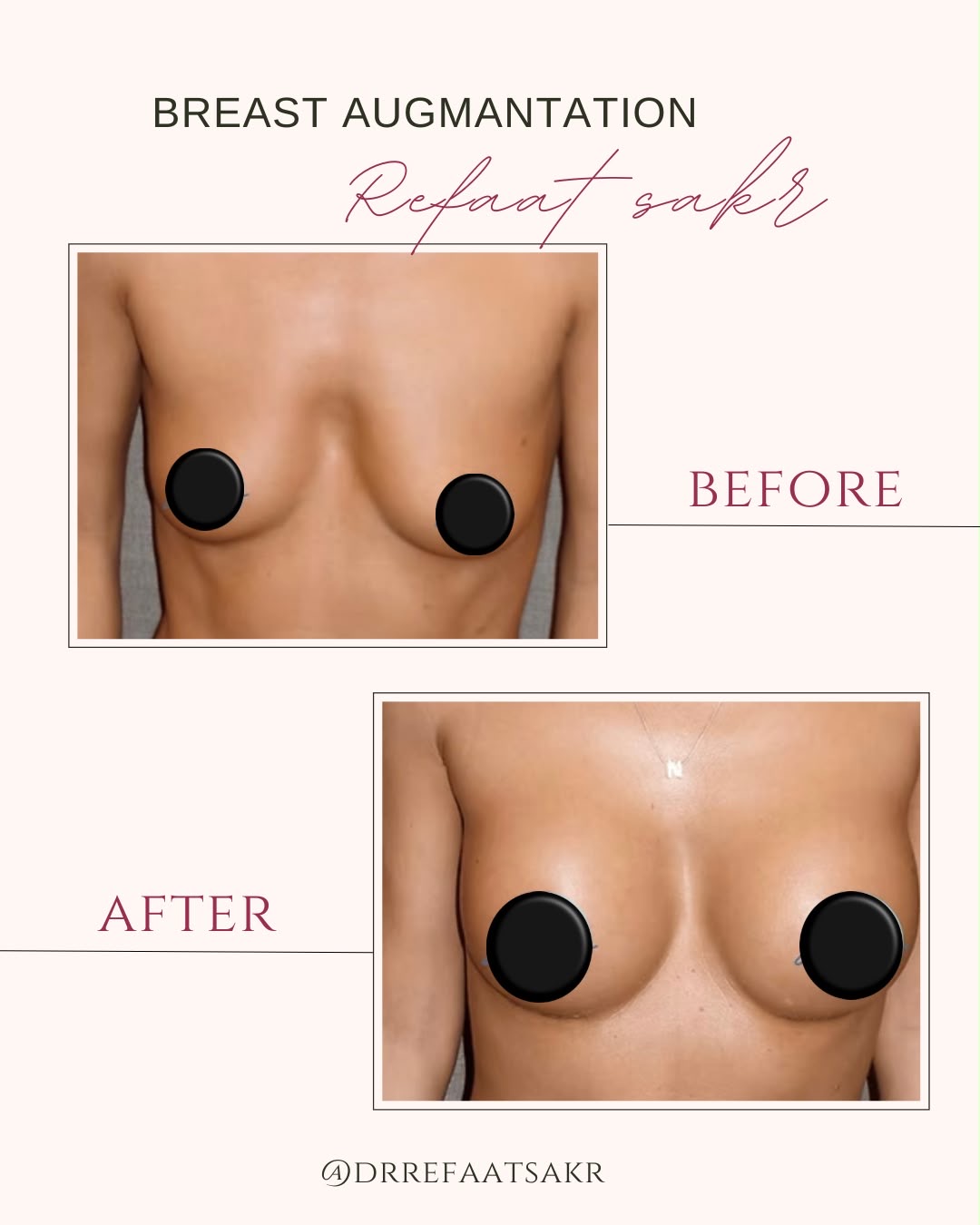 Result — Breast Augmentation