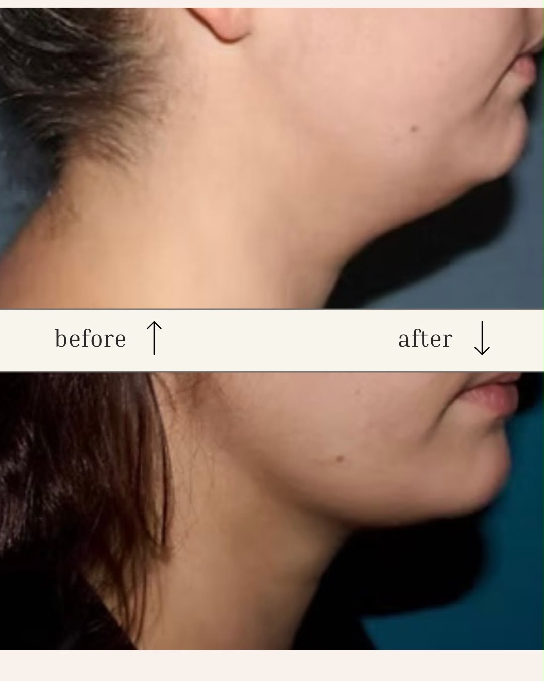 Result — Chin Liposuction